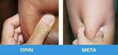 kitaritida-03 Κυτταρίτιδα – Λιπόλυση – Carboxytherapy