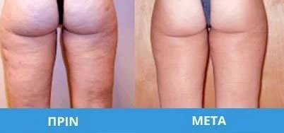 kitaritida-04 Κυτταρίτιδα – Λιπόλυση – Carboxytherapy