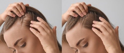 Woman,Before,And,After,Hair,Loss,Treatment,On,Grey,Background, Μάθετε τα πάντα για την τριχόπτωση: Αίτια, διάγνωση και θεραπεία