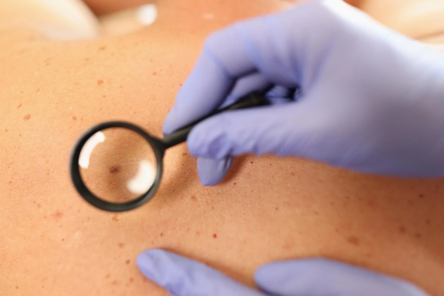 shmadia-karkinou-sto-derma